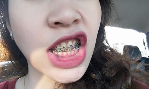 ยาสีฟัน whitening 3d ยาสีฟันสำหรับคนดัดฟัน